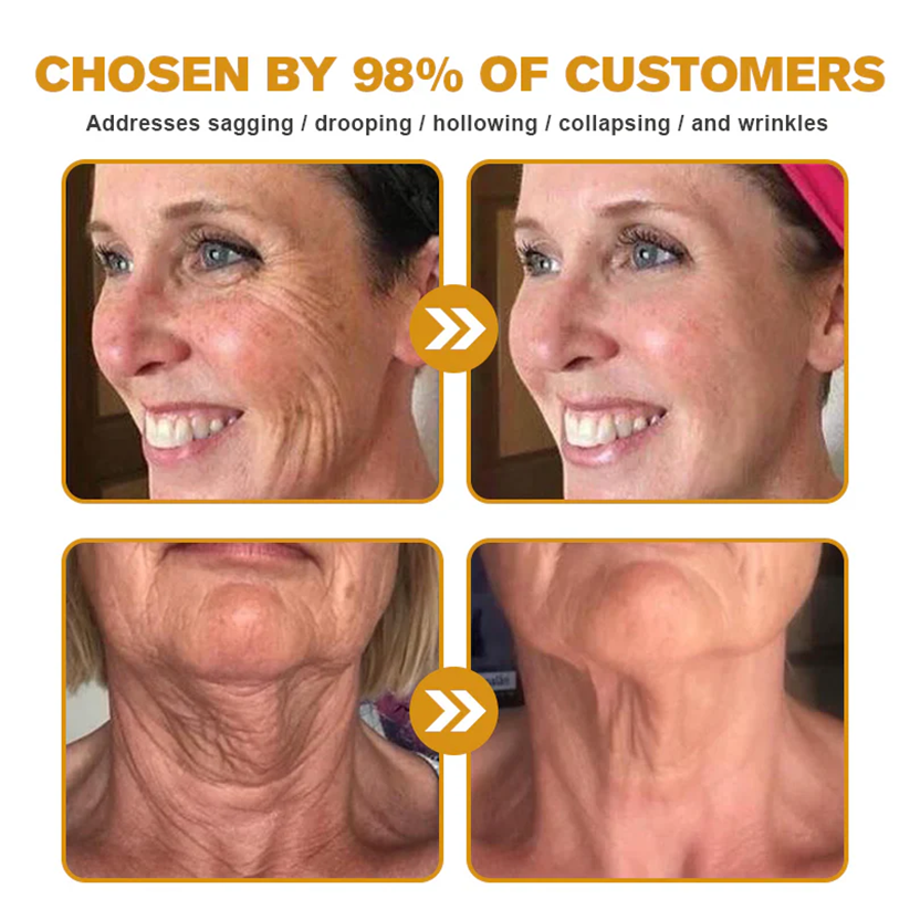 👨‍⚕️Dermatologist Recommended👨‍⚕️: Bee Venom · Botox Advanced Skin Rescue — Specifically Formulated for Paper-Thin, Fragile & Easy-Bruising Skin